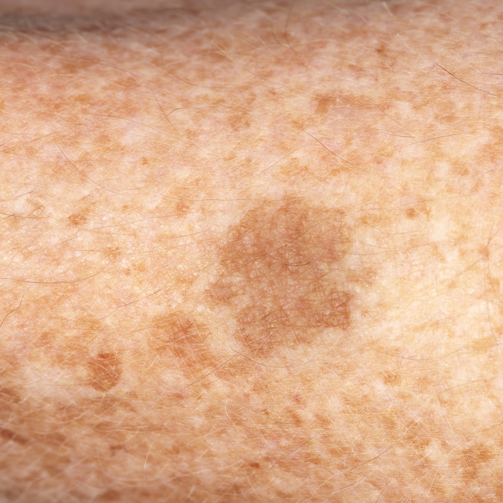 Freckles and large skin spots
